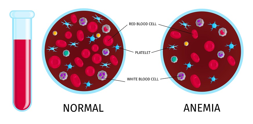 Anemia - A Common but Rarely Talked About Condition