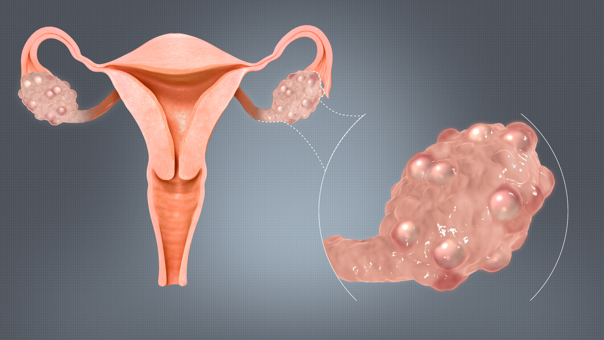 Polycystic Ovary Syndrome - Treatment Tips & Advice