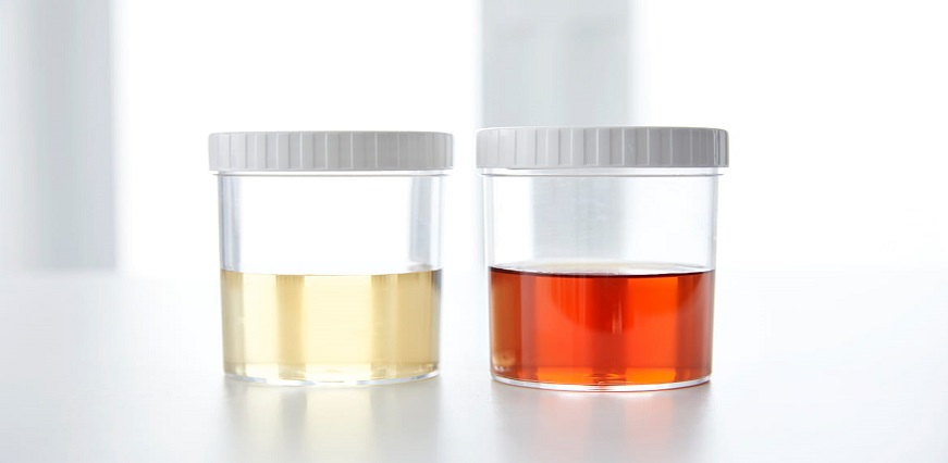 Blood in Urine: Causes, Tests, Treatment and Diagnosis