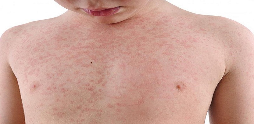 Rubella (German Measles): Symptoms, Causes, Treatment