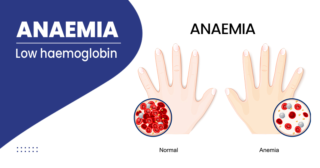 Anemia Symptoms - Causes, Diagnosis & Treatment | Max Lab