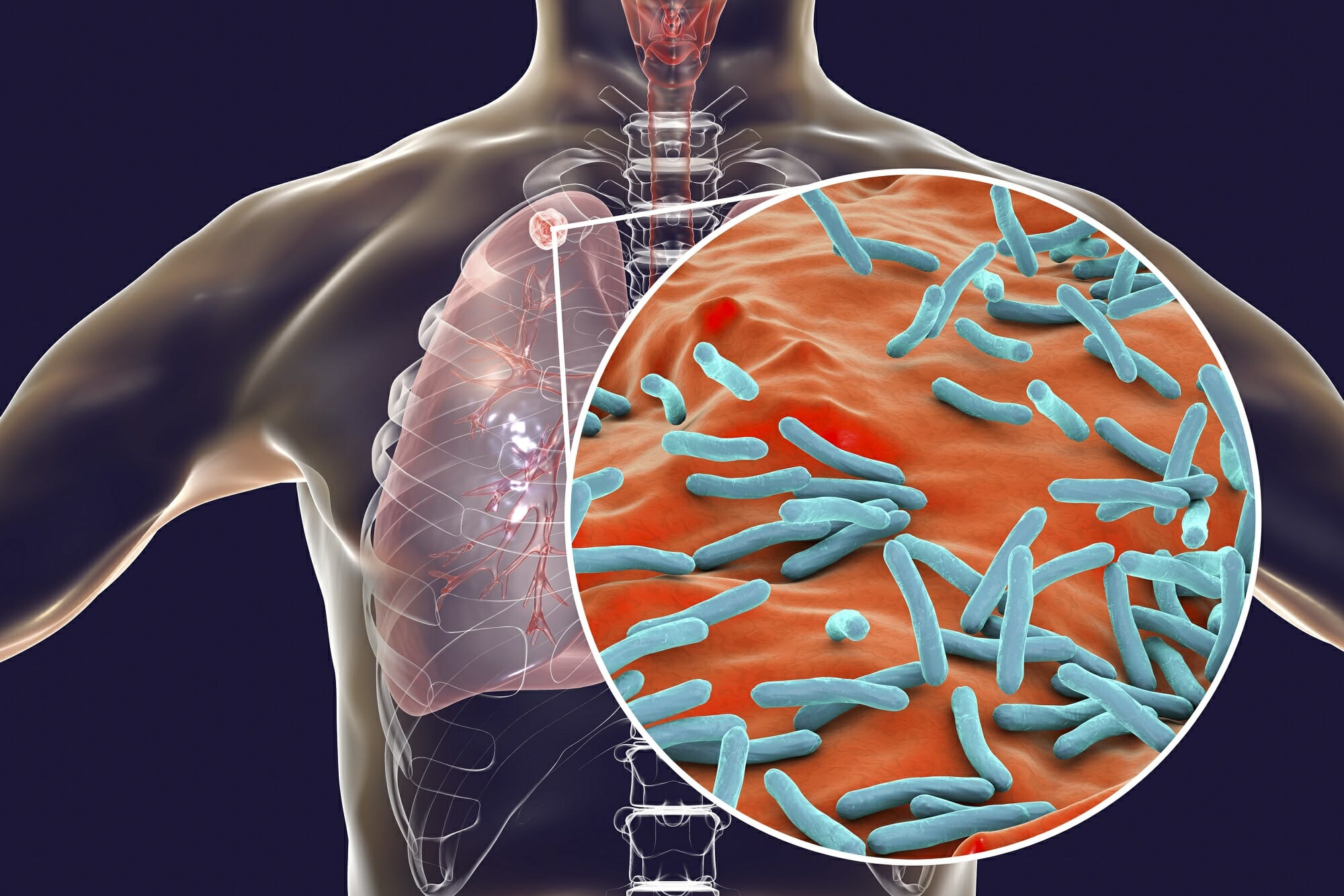 Tuberculosis Symptoms - Causes, Diagnosis & Treatment | Max Lab