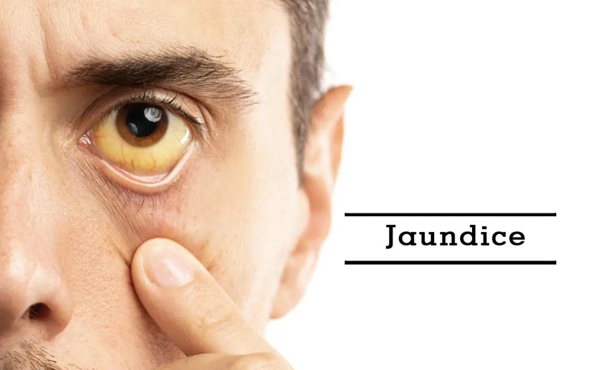 Jaundice Symptoms - Causes, Diagnosis, Treatment & Prevention