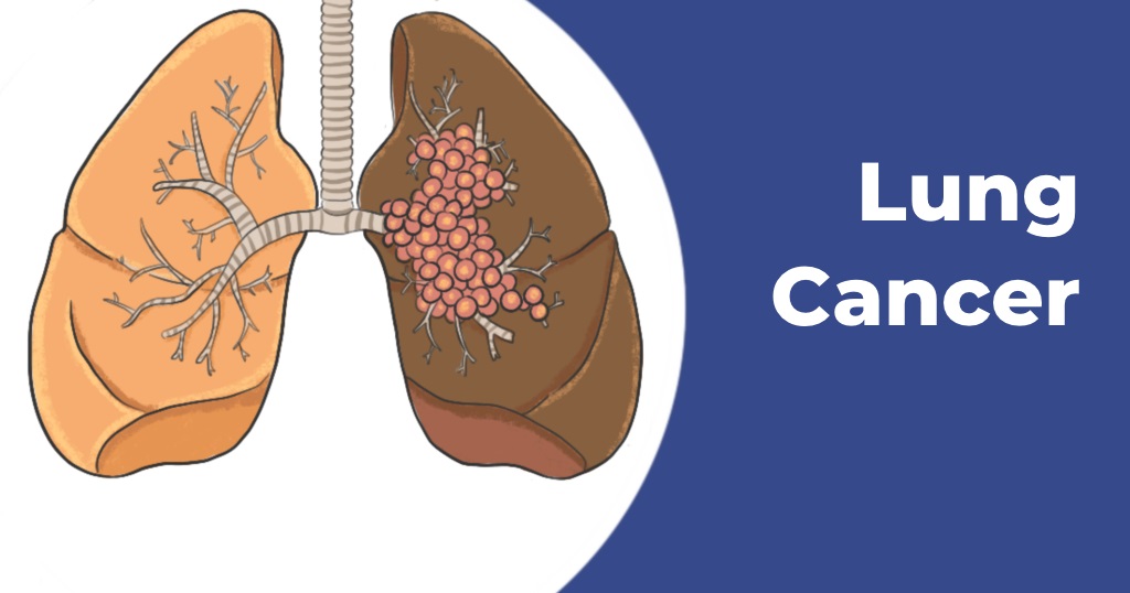 Lung Cancer Symptoms - Causes, Diagnosis, Treatment & Prevention