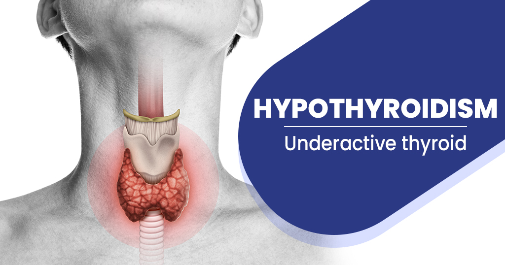 Hypothyroidism Symptoms - Causes, Diagnosis, Treatment & Prevention