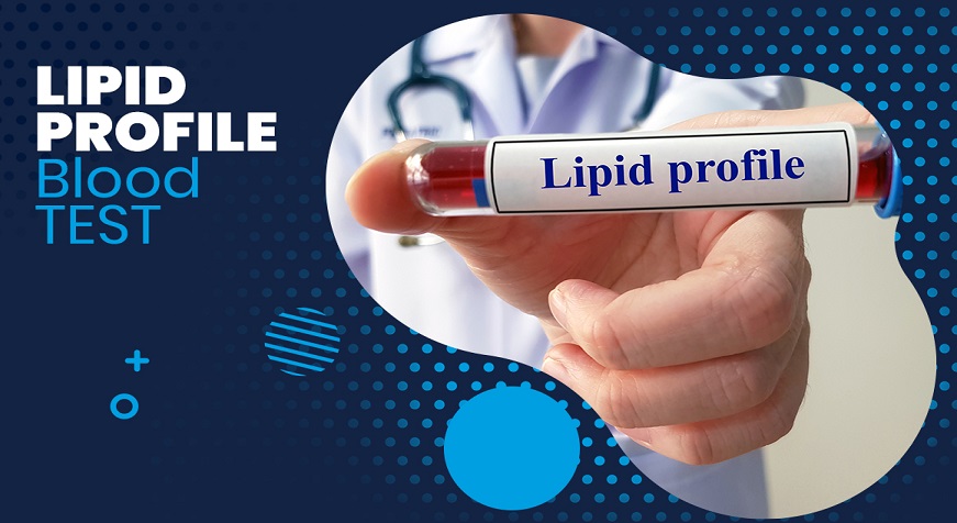 Lipid Profile Test: Introduction, Purpose, Levels, and Test Results