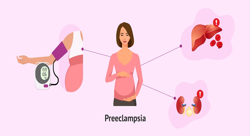 Preeclampsia - Causes, Symptoms, Diagnosis & Treatment