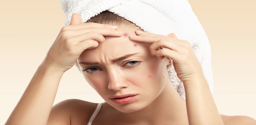 10 Effective and Safe Home Remedies for Acne or Pimples