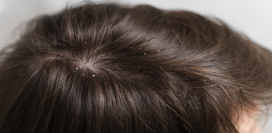 Home Remedies for Dandruff - Try These 5 Things | Max Lab