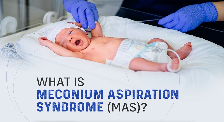 Meconium Aspiration Syndrome: Causes, Symptoms, and Diagnosis