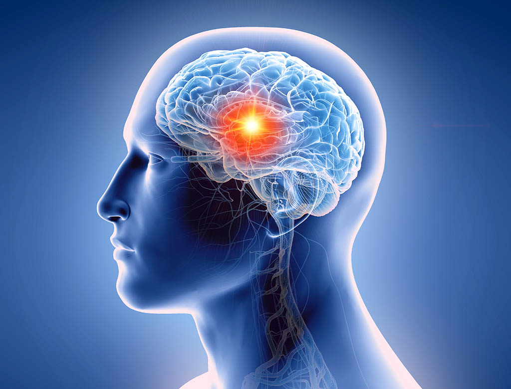 Brain Tumor Symptoms - Causes, Diagnosis & Treatment | Max Lab