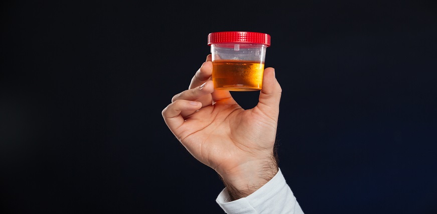 Top 5 Diseases That Can be Detected with a Simple Urine Test