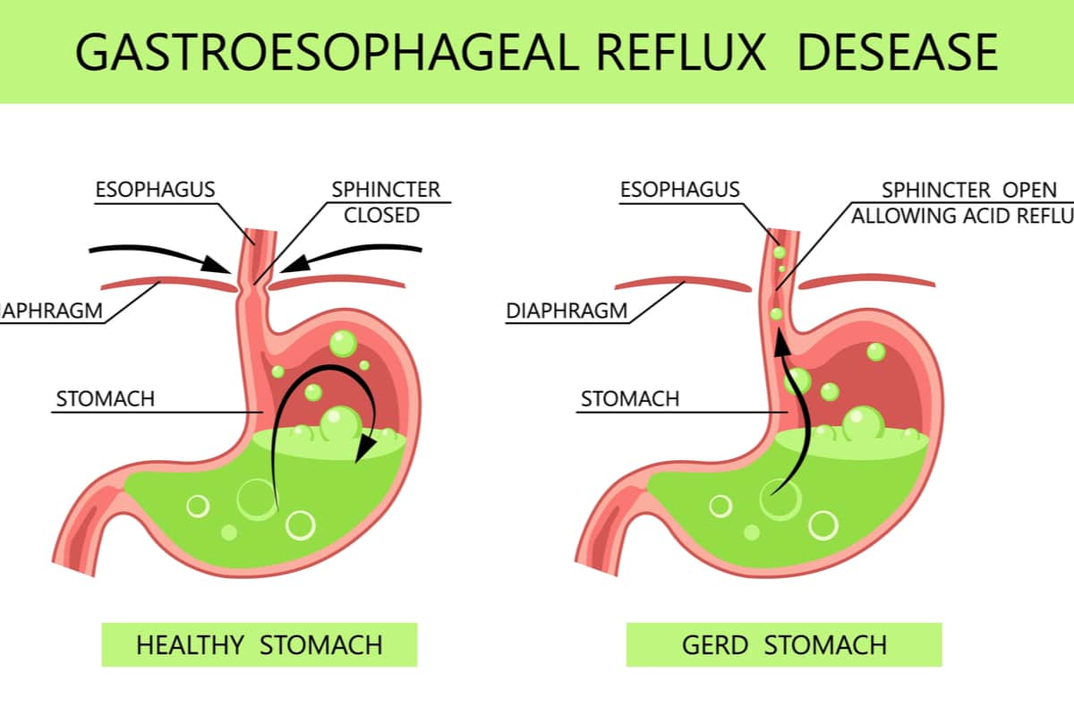 Gastro-Oesophageal Reflux Disease (GORD) - Symptoms, Causes & Treatment