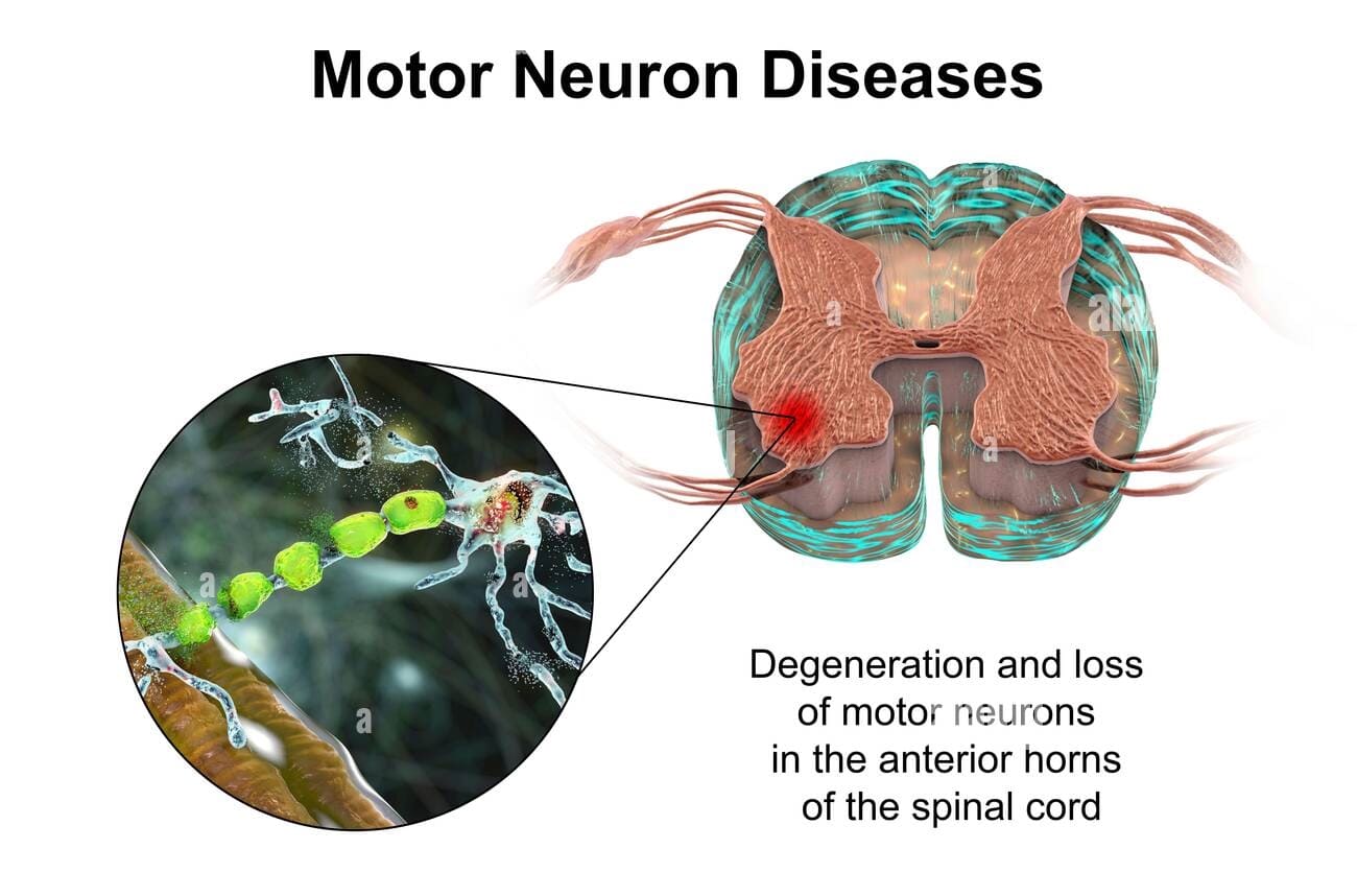 Motor Neuron Disease - Causes, Symptoms, Treatment