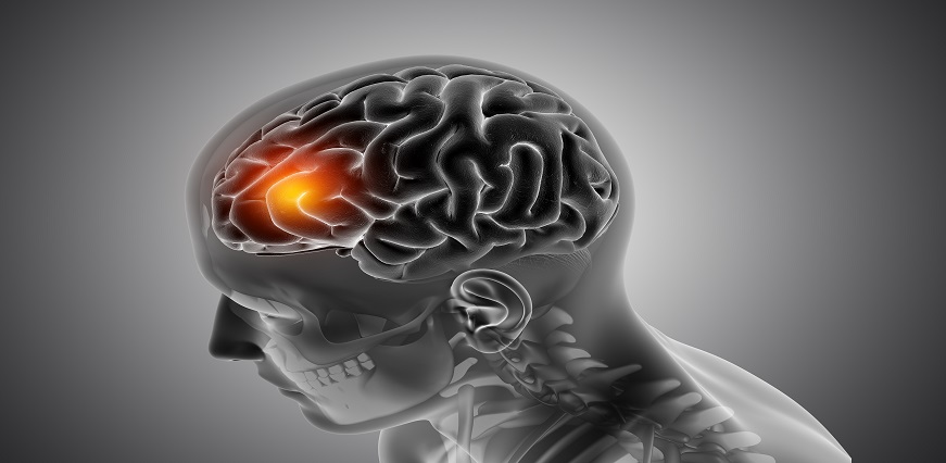 Brain Hemorrhage - Symptoms, Causes, Diagnosis & Treatment