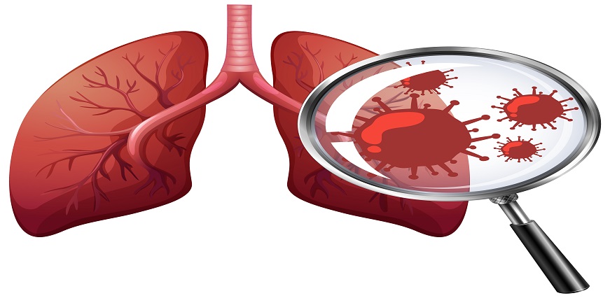 Pneumonia Symptoms - Causes, Diagnosis & Treatment | Max Lab