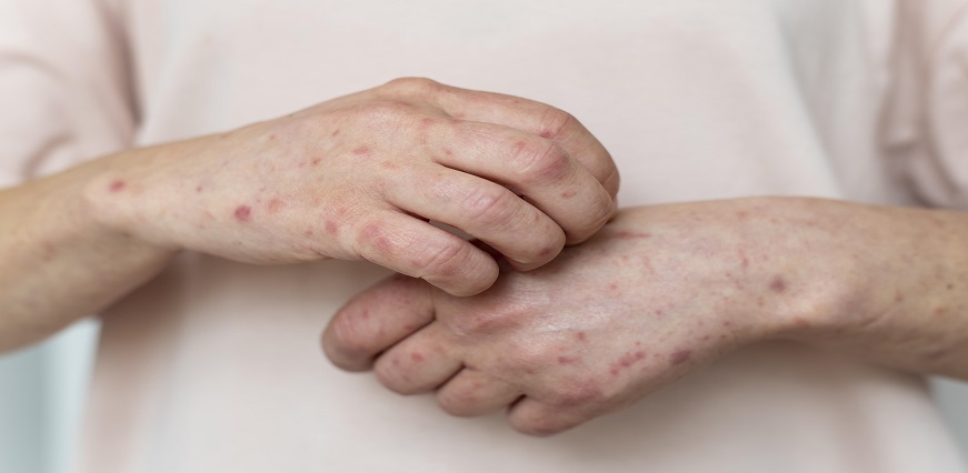 Hives: Types, Causes & Treatment