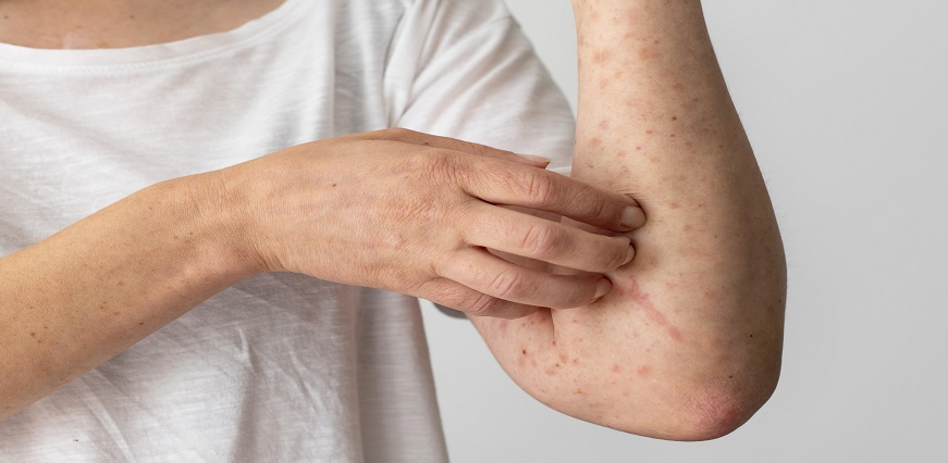 Ringworm (Dermatophytosis): Causes, Symptoms, Home Remedies, and the Best Treatments