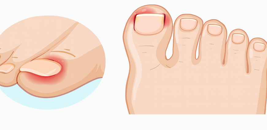 Nail Infections: Types, Causes, Symptoms and Treatments